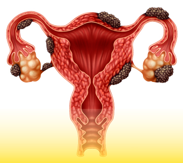 Endometriose CEAGIC