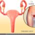 Mioma uterino